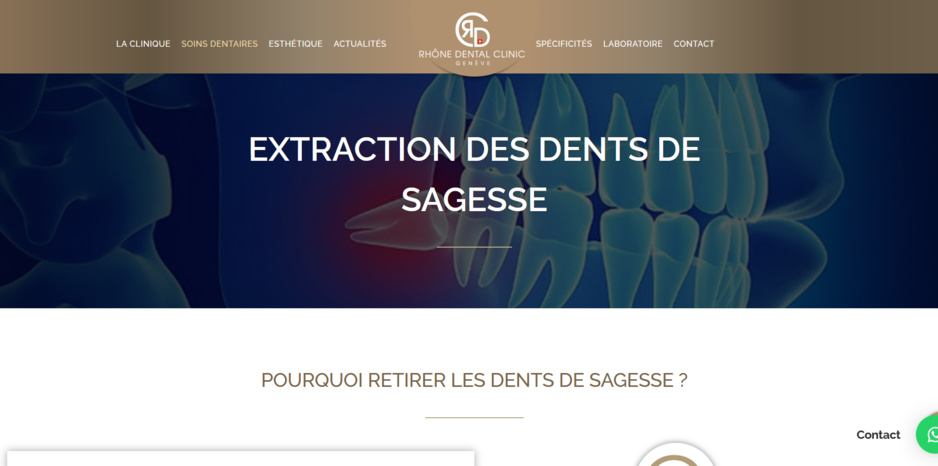 Quand faut-il extraire les dents de sagesse ?