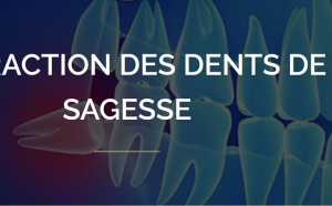 Quand faut-il extraire les dents de sagesse ?